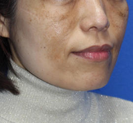 50代女性のレーザートーニング Before 症例写真