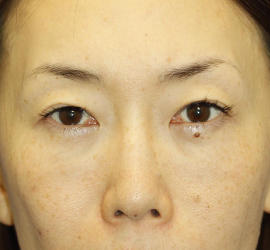40代女性の目の下のクマ治療 After 症例写真