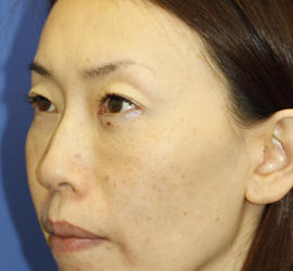 40代女性の3Dリポアイリフト  After 症例写真