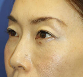 40代女性の3Dリポアイリフト  After 症例写真