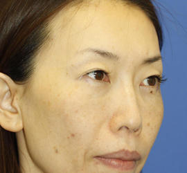 40代女性の3Dリポアイリフト  After 症例写真