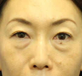 40代女性の目の下のクマ治療 Before 症例写真