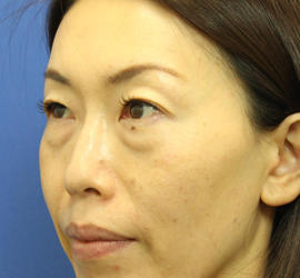 40代女性の3Dリポアイリフト  Before 症例写真