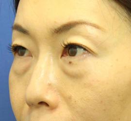 40代女性の3Dリポアイリフト  Before 症例写真