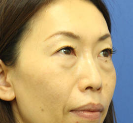 40代女性の3Dリポアイリフト  Before 症例写真