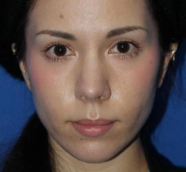 20代女性のヒアルロン酸注射（唇） After 症例写真