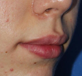 20代女性のヒアルロン酸注射（唇） After 症例写真