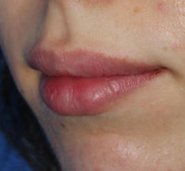 20代女性のボトックス （口角） After 症例写真