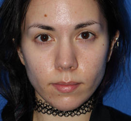 20代女性のヒアルロン酸注射（唇） Before 症例写真