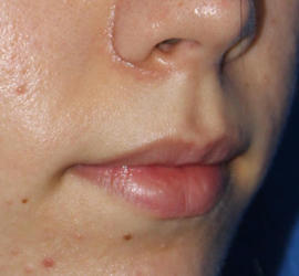 20代女性のヒアルロン酸注射（唇） Before 症例写真