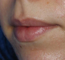 20代女性のボトックス （口角） Before 症例写真