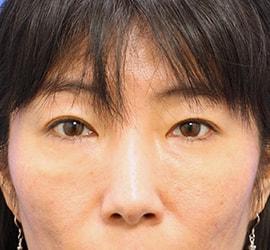 40代女性の目の下の脱脂 After 症例写真