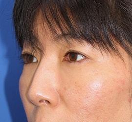 40代女性の目の下の脱脂  After 症例写真