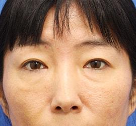 40代女性の目の下の脱脂 Before 症例写真