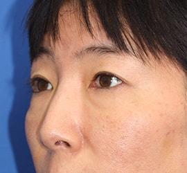 40代女性の目の下の脱脂  Before 症例写真