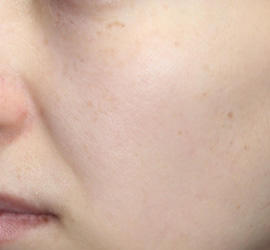 30代女性のフォトRF（SR） After 症例写真