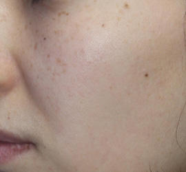 30代女性のフォトRF（SR） Before 症例写真