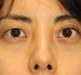 30代女性の目の下の脱脂  After 症例写真