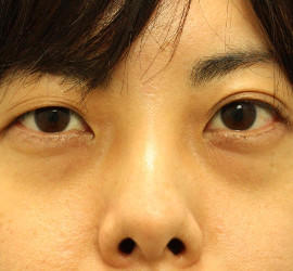 30代女性の目の下の脱脂  Before 症例写真