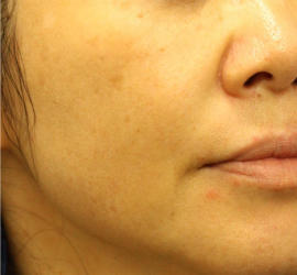 50代女性のリジュランHB After 症例写真