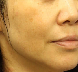 50代女性のリジュランHB Before 症例写真