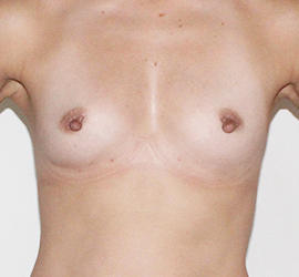 40代女性のピュアグラフト豊胸 After 症例写真