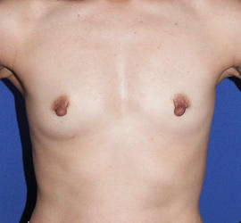 40代女性のピュアグラフト豊胸 Before 症例写真