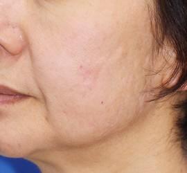 50代女性のフラクセル After 症例写真