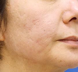 50代女性のフラクセル After 症例写真