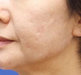 50代女性のフラクセル Before 症例写真