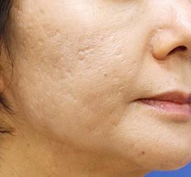 50代女性のフラクセル Before 症例写真