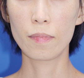 40代女性のシミ・そばかす After 症例写真