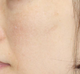 40代女性のレーザートーニング After 症例写真