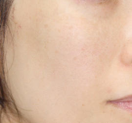 40代女性のレーザートーニング After 症例写真