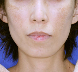 40代女性のシミ・そばかす Before 症例写真