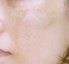 40代女性のレーザートーニング Before 症例写真