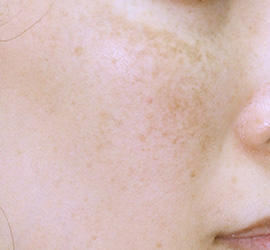 40代女性のレーザートーニング Before 症例写真