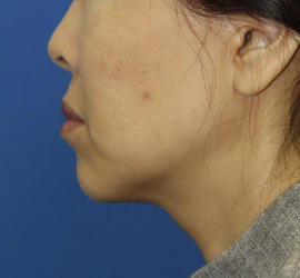 50代女性の顔の脂肪吸引  After 症例写真