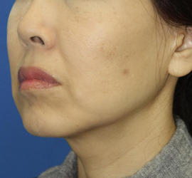 50代女性の顔の脂肪吸引  After 症例写真