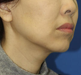 50代女性のシワ・たるみ After 症例写真