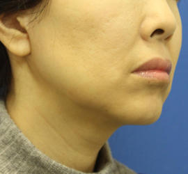 50代女性の顔の脂肪吸引  After 症例写真