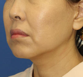 50代女性の顔の脂肪吸引  Before 症例写真