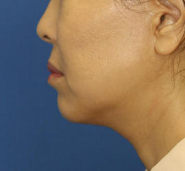 50代女性の顔の脂肪吸引  Before 症例写真