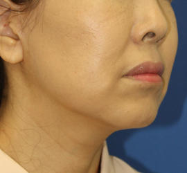 50代女性のシワ・たるみ Before 症例写真