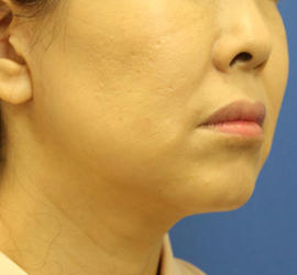 50代女性の顔の脂肪吸引  Before 症例写真