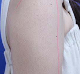 30代女性の毛孔性苔癬・角化症 Before 症例写真