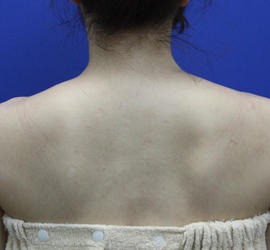 40代女性のボトックス（美肩・肩こり解消） After 症例写真