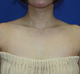 40代女性のボトックス（美肩・肩こり解消） After 症例写真