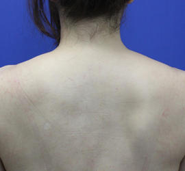 40代女性のボトックス（美肩・肩こり解消） Before 症例写真