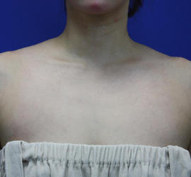 40代女性のボトックス（美肩・肩こり解消） Before 症例写真